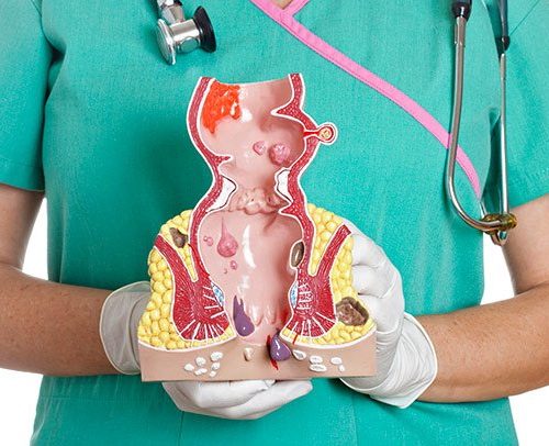 علاج البواسير