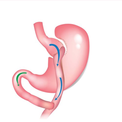 عملية تحويل مسار المعدة في تركيا
