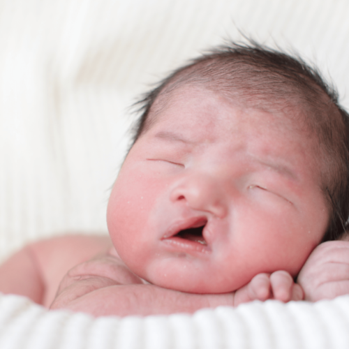 عملية الشفة الأرنبية