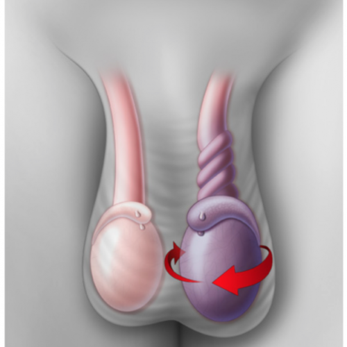الدكتور-توفيق-البوسطة التواء الخصية